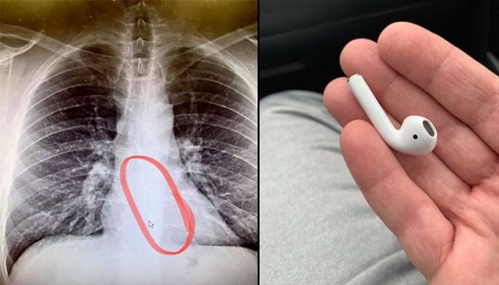 Man swallows Apple AirPods while sleeping: Music వింటూ నిద్రపోయాడు.. నిద్రలో Apple AirPods మింగేశాడు..