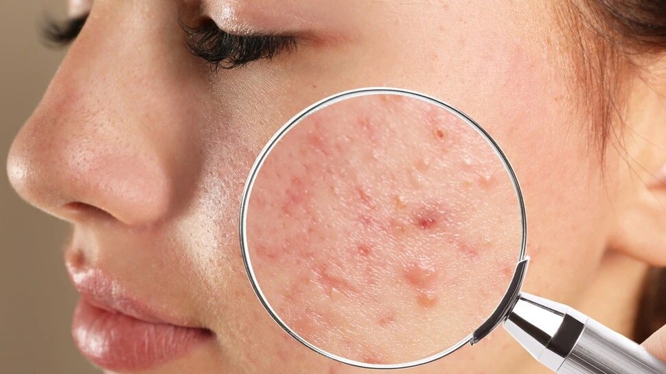 Acne Problem: ముఖంపై మొటిమలు రాకుండా ఉండాలంటే తీసుకోవల్సిన జాగ్రత్తలు ఇవే