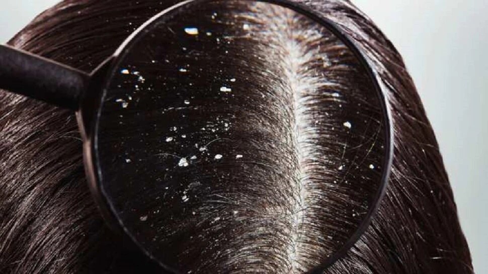 Dandruff Home Remedies: Here is a permanent solution to reduce the problem of dandruff | Dandruff Home Remedies: చుండ్రు సమస్యను తగ్గించుకోవడానికి శాశ్వత పరిష్కారం ఇదిగో! | హెల్త్ News in Telugu Dandruff Home Remedies: Here is a permanent solution to reduce the problem of dandruff | Dandruff Home Remedies: చుండ్రు సమస్యను తగ్గించుకోవడానికి శాశ్వత పరిష్కారం ఇదిగో! | హెల్త్ News in Telugu