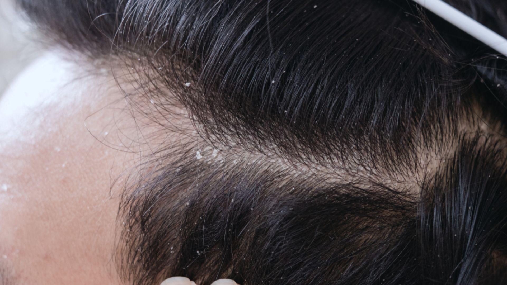 How To Get Rid Of Dandruff: జుట్టు చుండ్రు సమస్యలతో బాధపడుతున్నారా.. ఈ చిట్కాలను ఉపయోగించి విముక్తి పొందండి..!