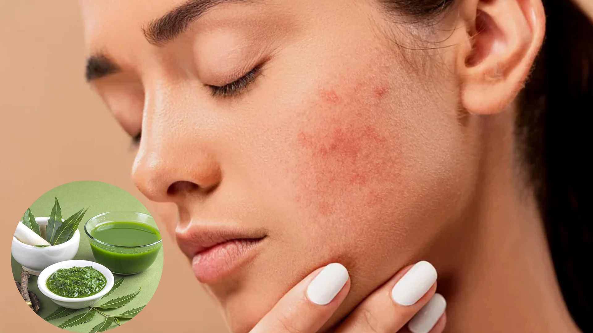 Neem Leaves Benefits Neem Leaves Protect Against Skin Problems Apply