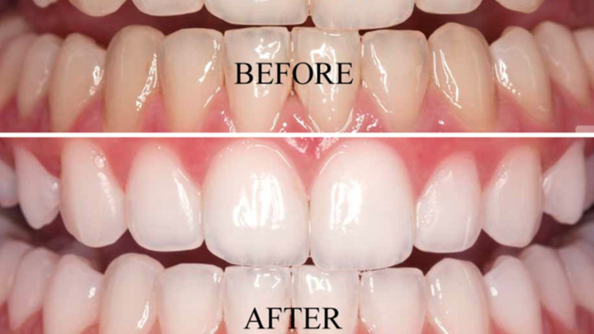 Teeth Whitening At Home Are You Suffering From Teeth Problem Get