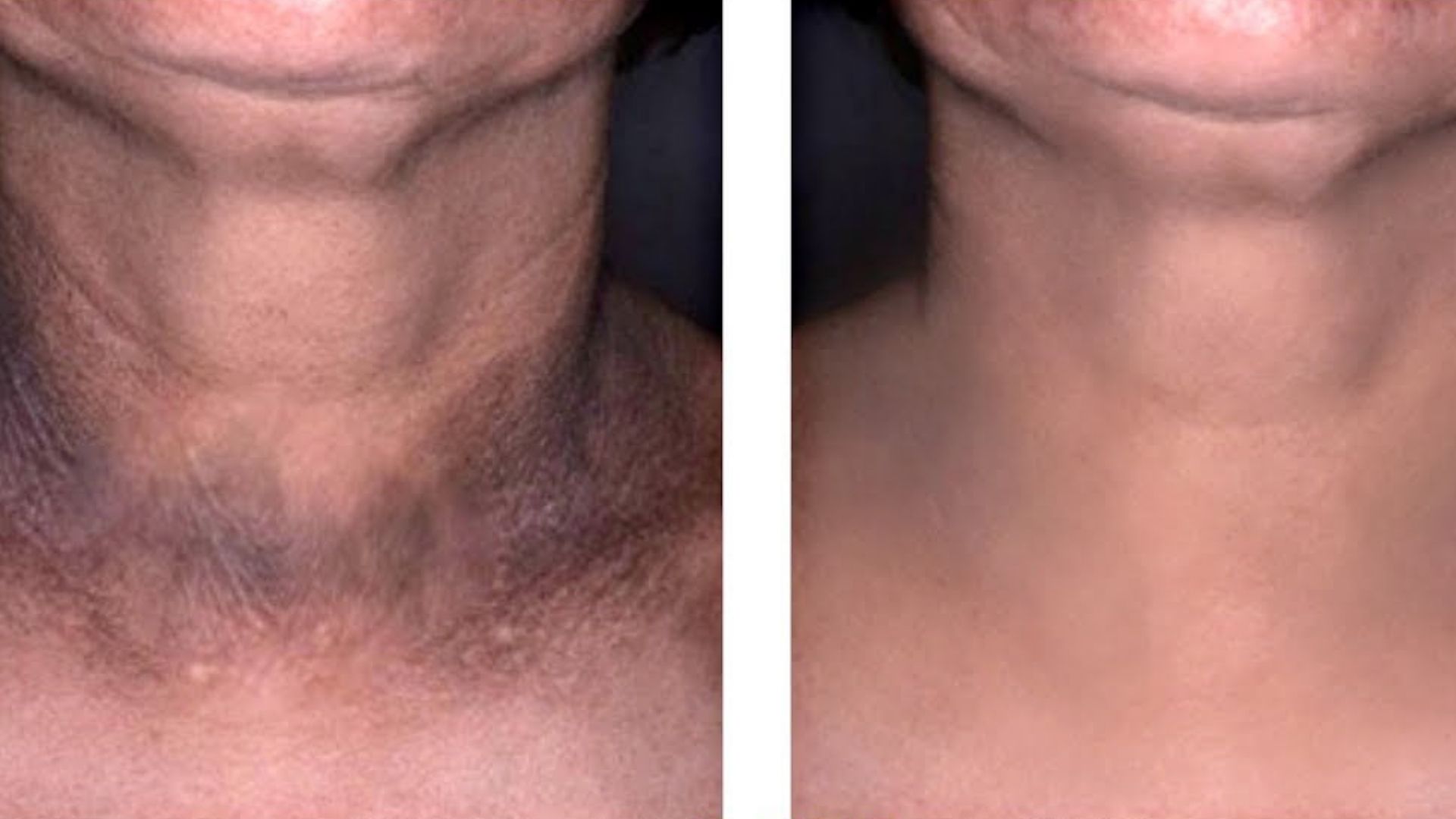 home-remedies-for-dark-neck-skin-turning-black-on-the-neck-get-relief