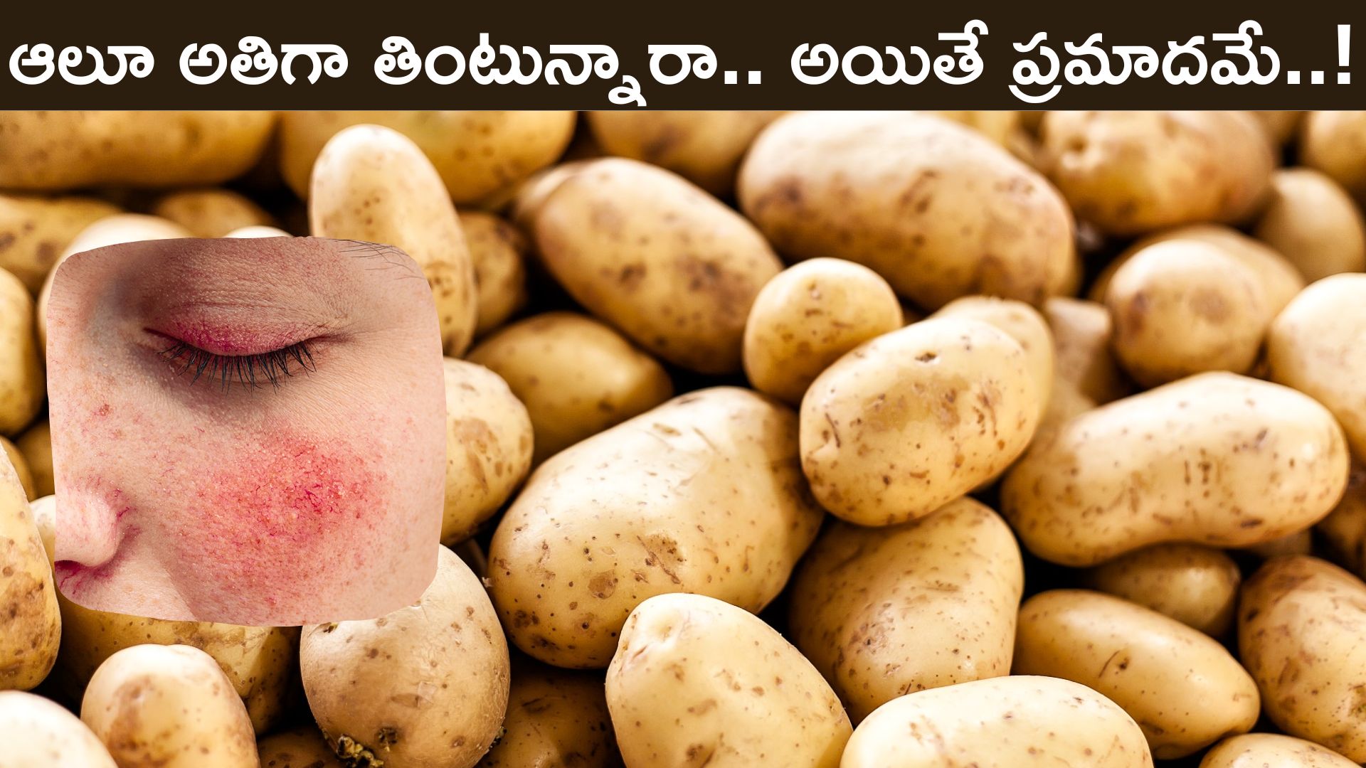 Skin Care Tips Eating Too Much Potato Can Cause Skin Problems And