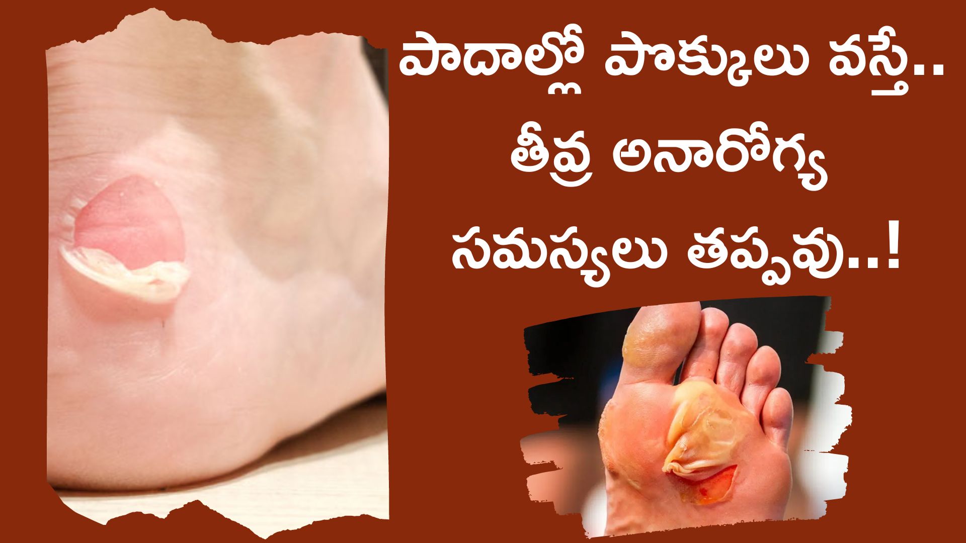 Diabetes Risk Factors: డయాబెటిస్ ఉన్నవారిలో తరచుగా పాదాల్లో పొక్కులు వస్తే.. తీవ్ర అనారోగ్య సమస్యలు రావొచ్చు..!