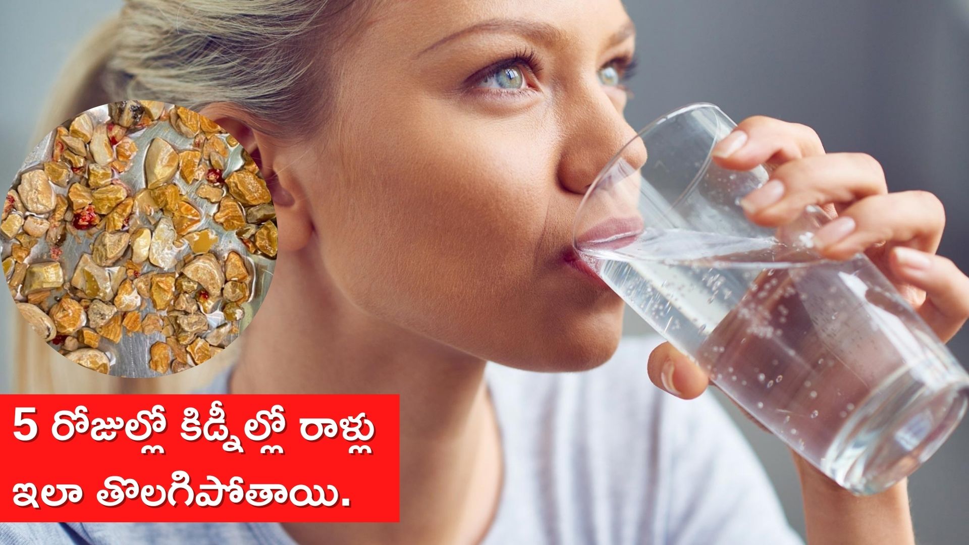 Kidney Stone Treatment If You Drink 10 To 12 Glasses Of Water Daily