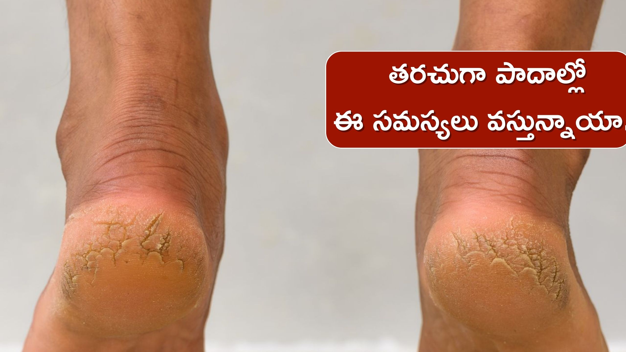 Cracked Heels: Lack Of Vitamin C E And B3 In The Body Causes ...