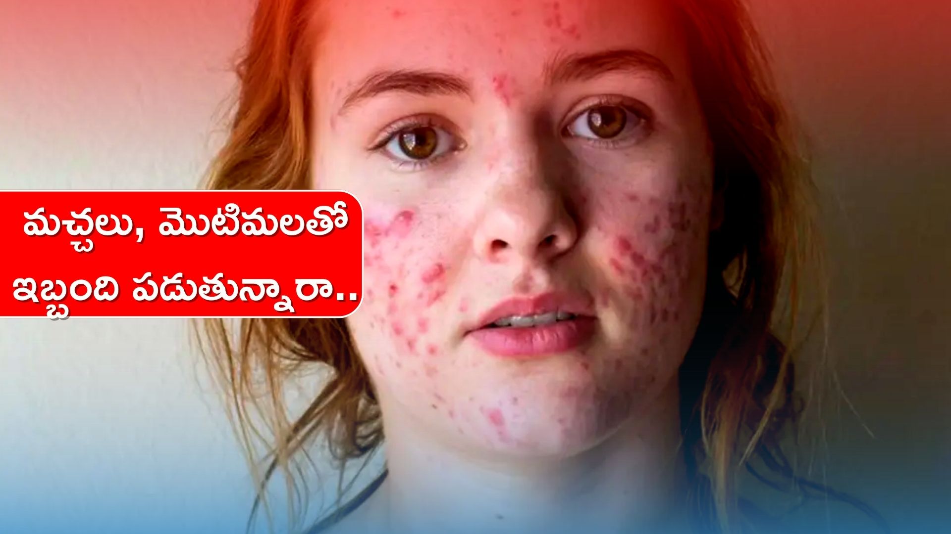 How To Get Rid Of Pimples Acne Taking Vitamin A Vitamin K And Vitamin