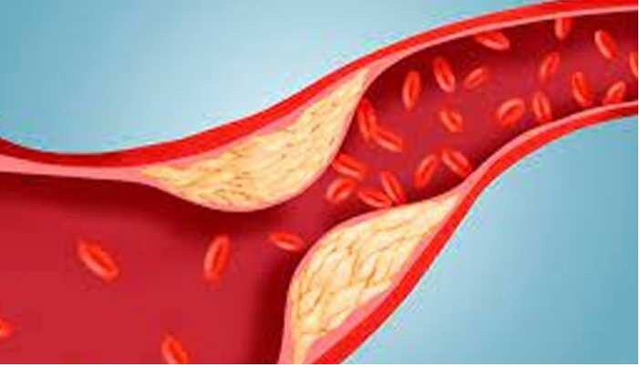 Cholesterol Tips: ఈ ఆహార పదార్ధాలు తీసుకుంటే కేవలం 21 రోజుల్లో కొలెస్ట్రాల్‌కు చెక్