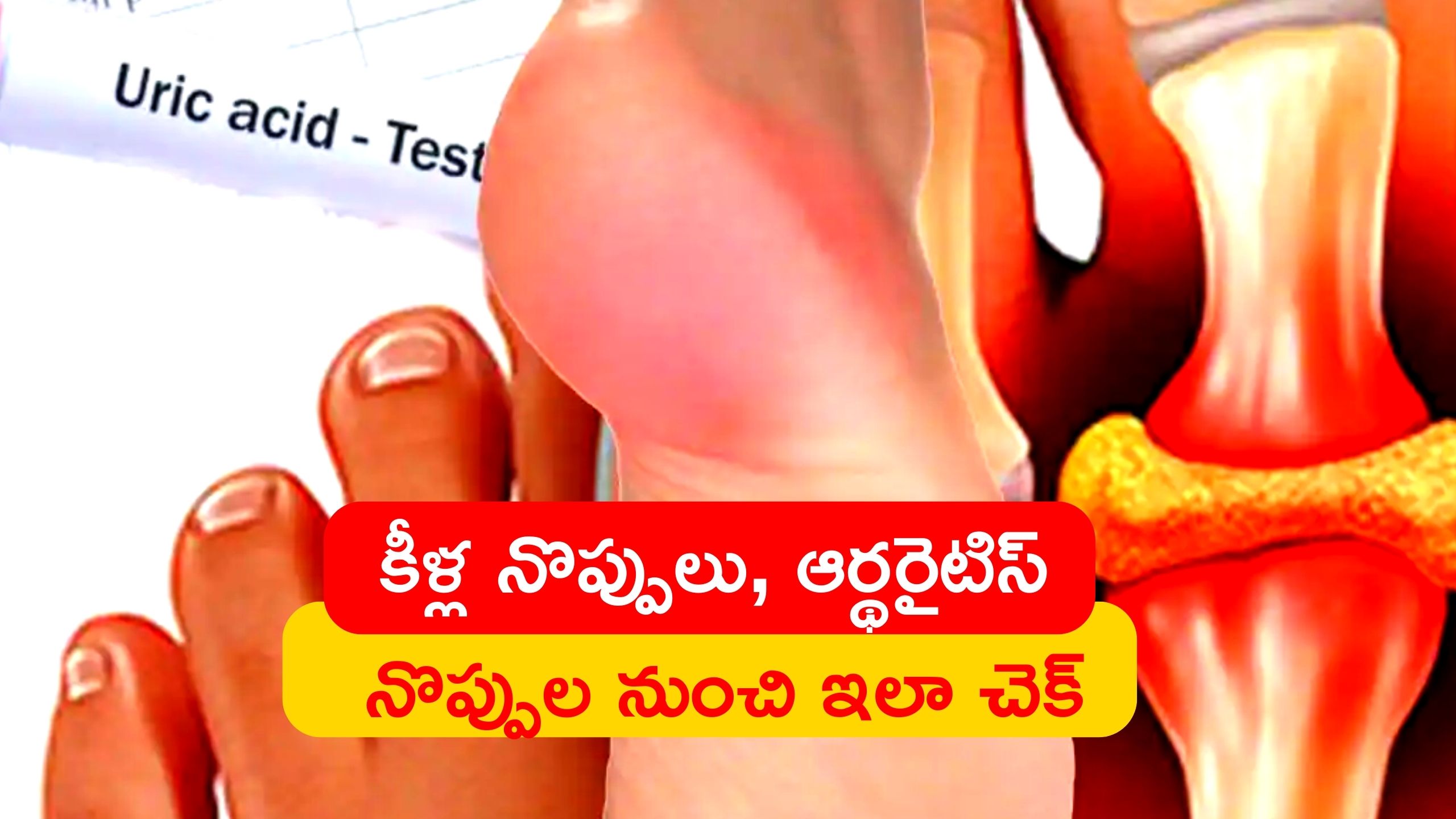 Uric Acid Control Diet Eating Cashews Walnuts And Almonds Every Day