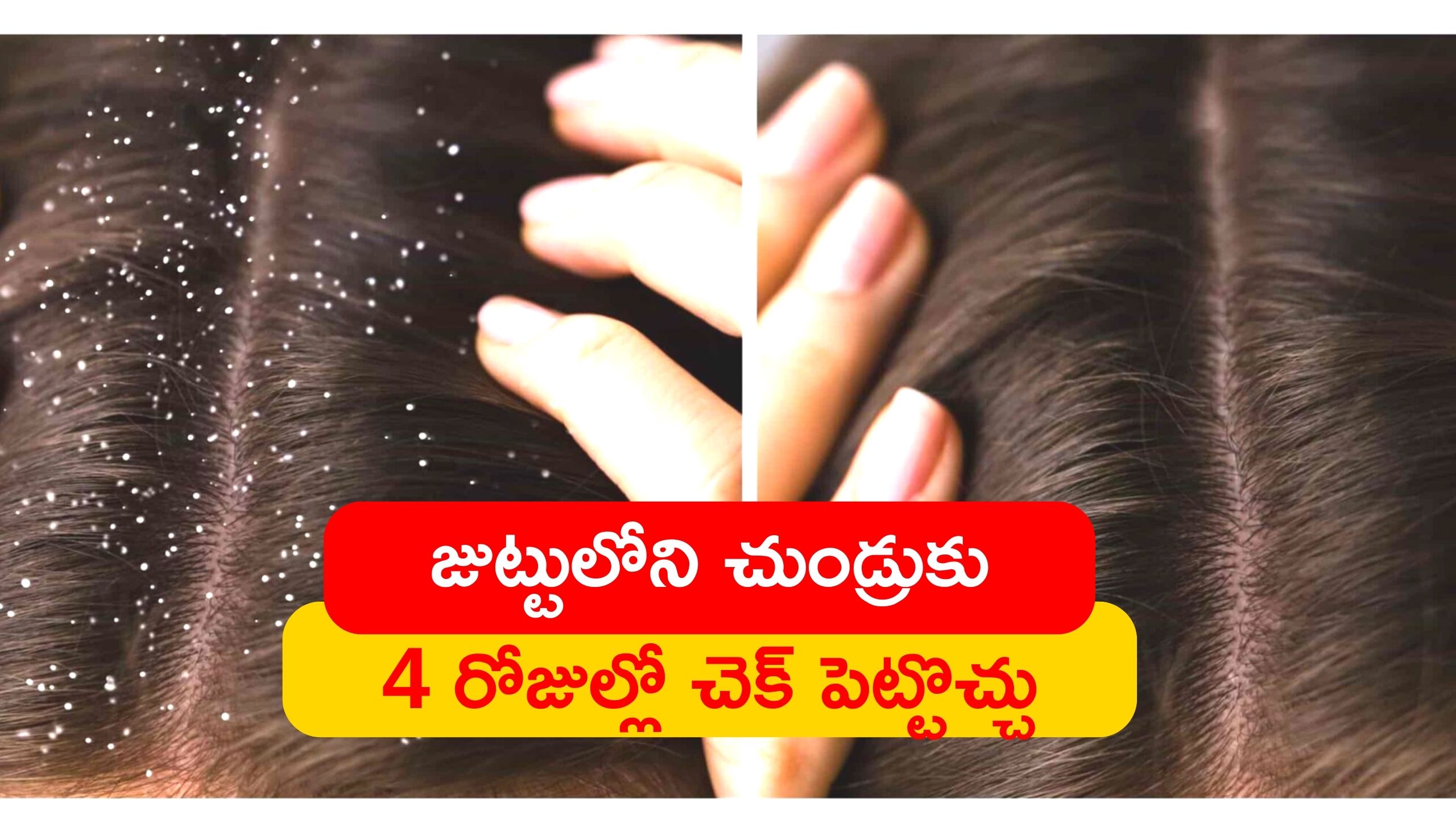 Dandruff Control Tips Applying Neem Leaves Coconut Oil Curd And Apple