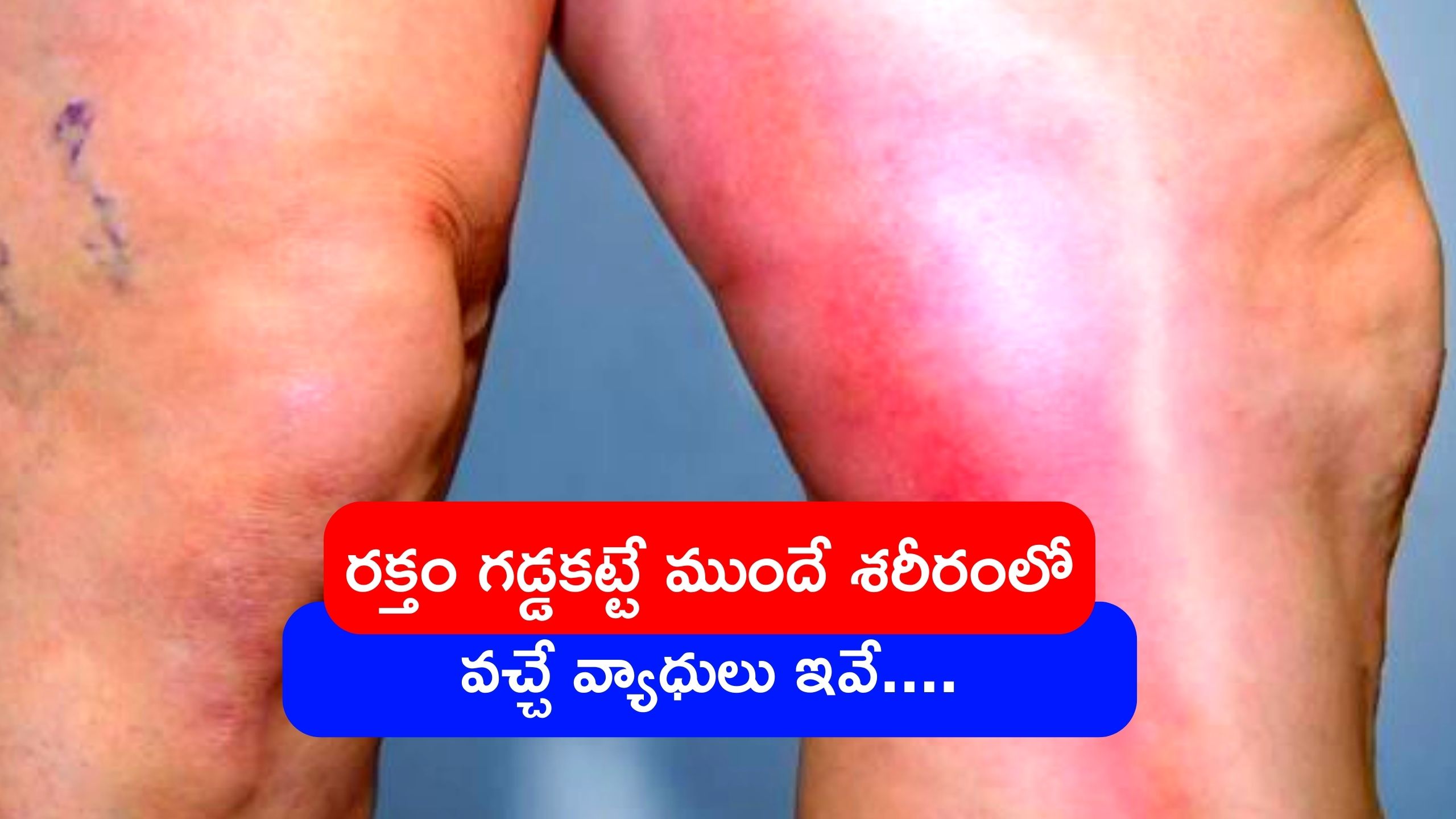 Blood Clot Signs &amp; Symptoms: రక్తం గడ్డకట్టే ముందే శరీరంలో ఈ చిన్న చిన్న వ్యాధులు వస్తాయి..జాగ్రత్తలు పాటించకపోతే ప్రమాదమే..