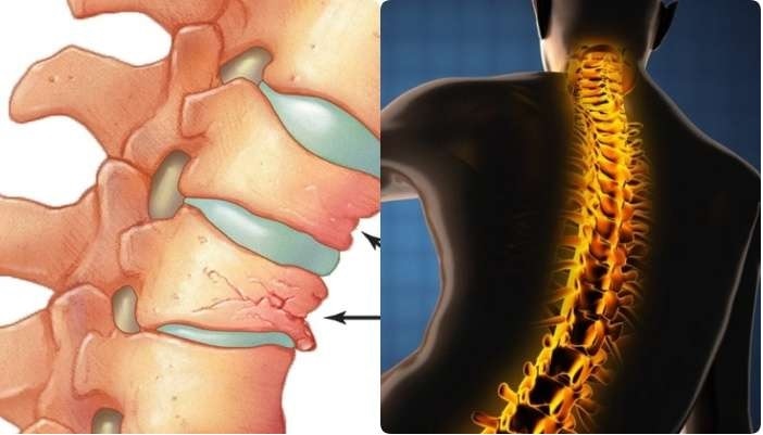 Calcium Deficiency: కాల్షియం లోపముంటే రికెట్స్, ఆస్టియోపోరోసిస్ తప్పదా, ఎలాంటి పదార్ధాలు తీసుకోవాలి