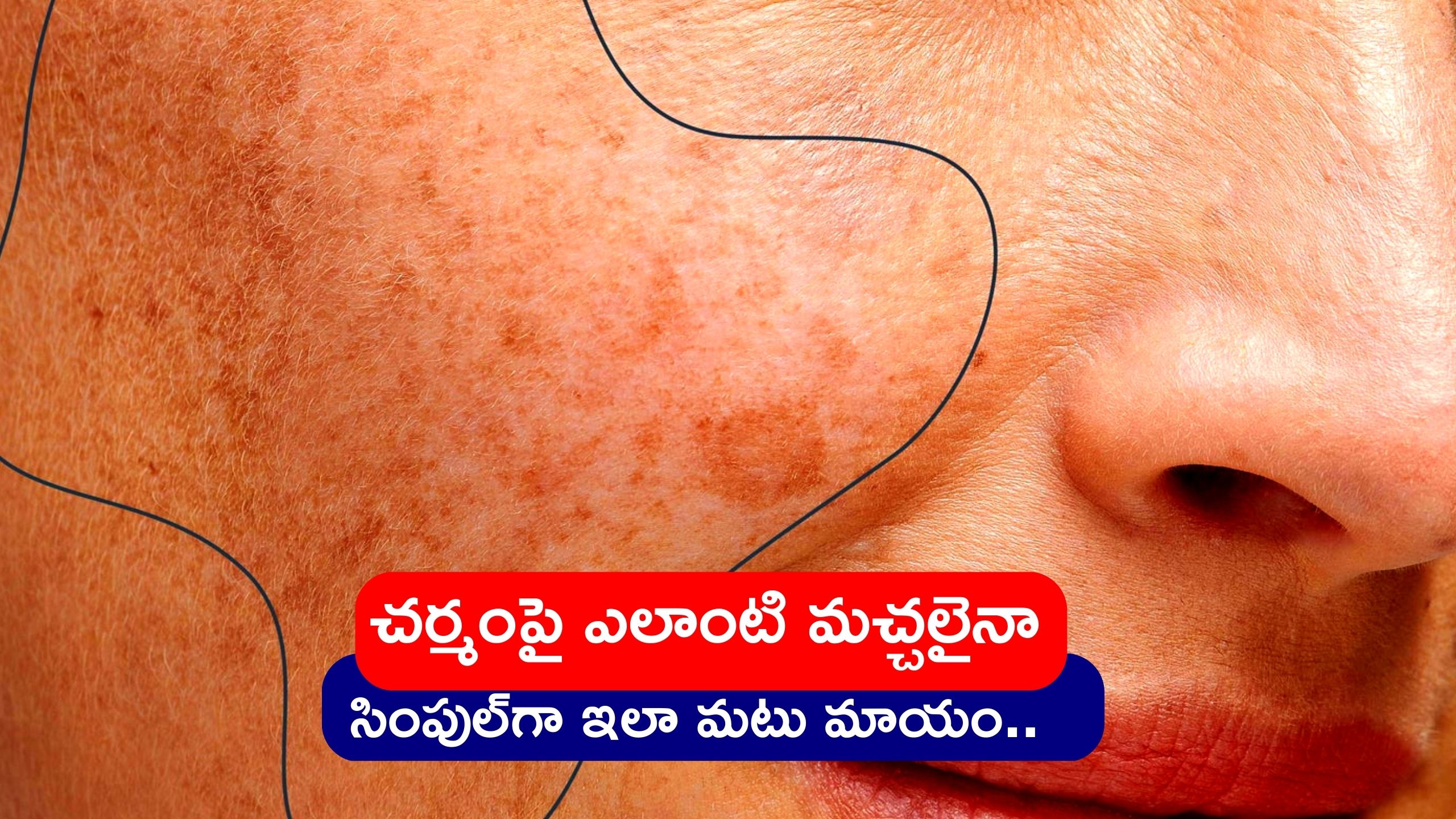 Pigmentation Home Remedies: చర్మంపై ఎలాంటి మచ్చలైనా నయా పైసా ఖర్చులేకుండా ఇలా మటు మాయం..