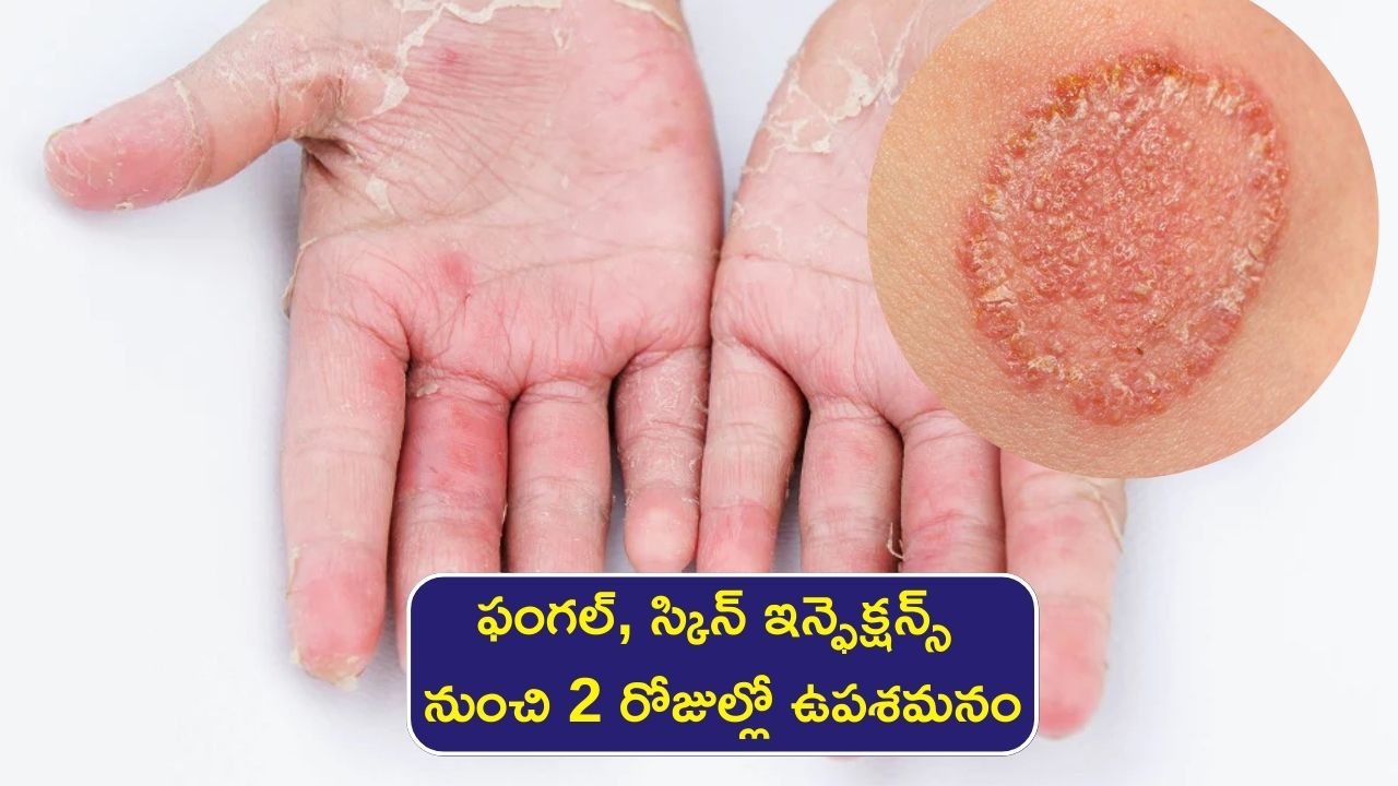 Skin Fungal Infection Daily Applly Tea Tree Oil Aloe Vera Gel And Neem