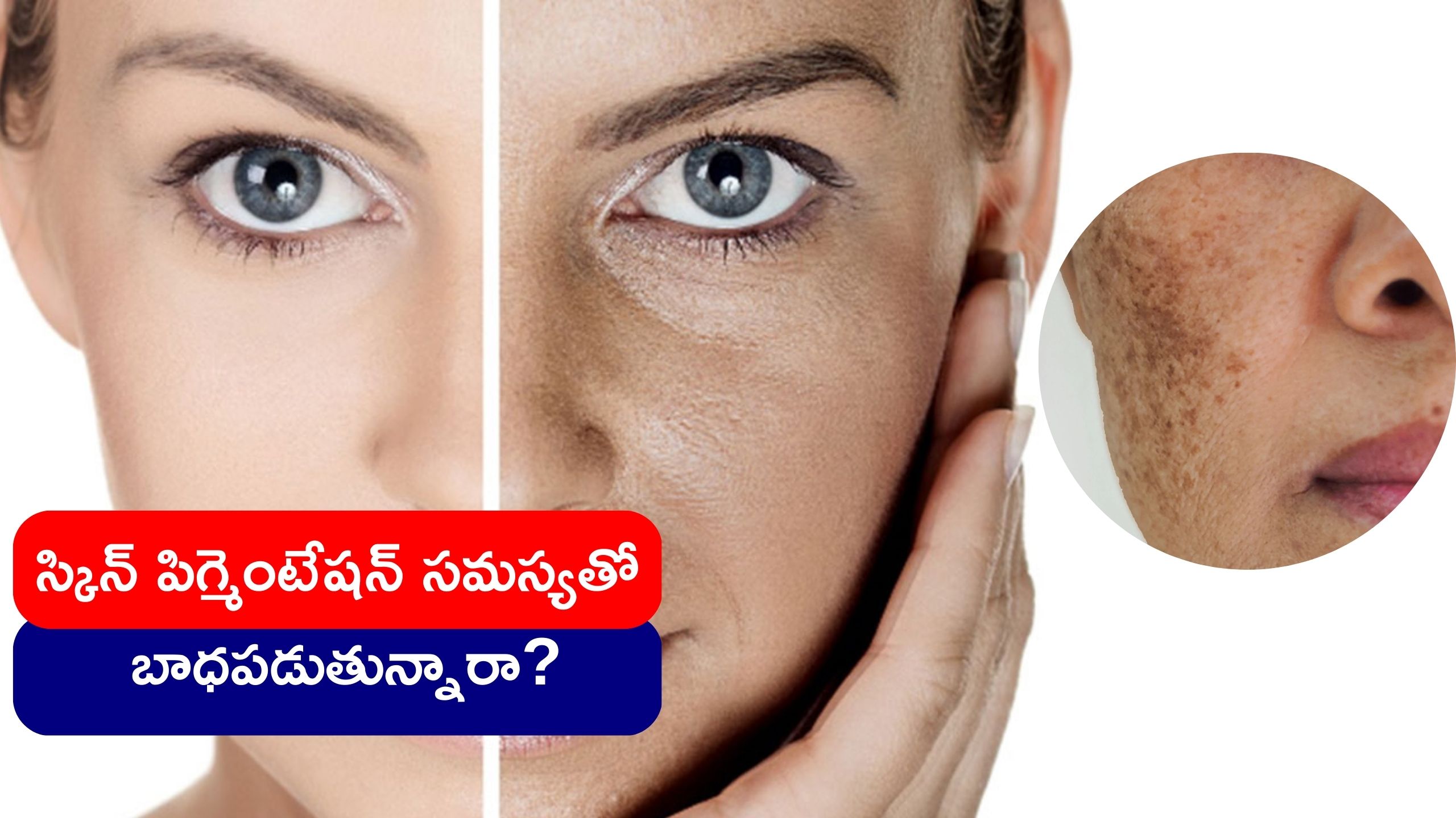Home Remedies For Pigmentation Applying Red Onion Honey Lemon Juice