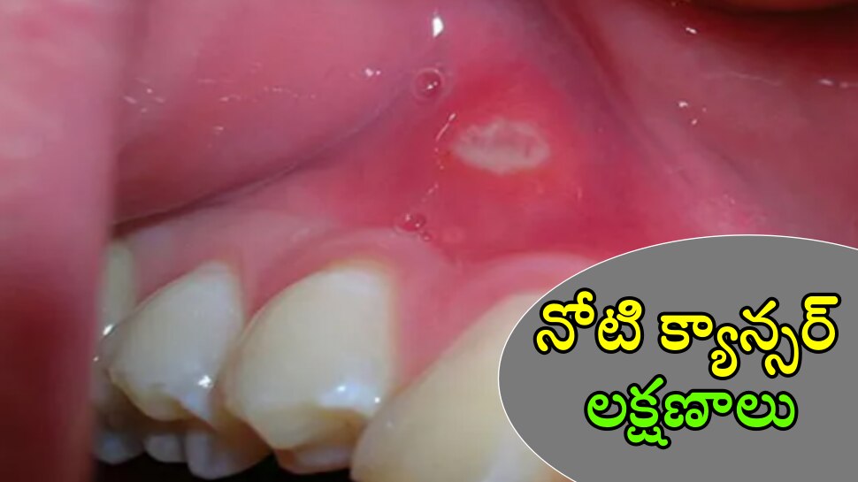 Oral Cancer: మీరు తరుచూ ఆ పని చేస్తున్నారా..  అయితే మీకు నోటి క్యాన్సర్ ఉన్నట్లే..