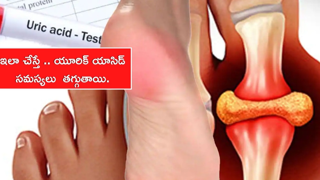 Uric Acid Alert: ఈ పదార్ధాలు మీ శరీరంలో యూరిక్ యాసిడ్ పెంచేస్తాయి తస్మాత్ జాగ్రత్త