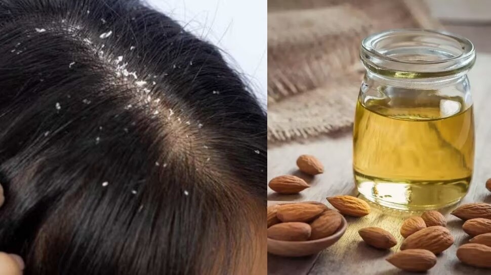 Hair care tips and precautions for dandruff problem apply almond oil