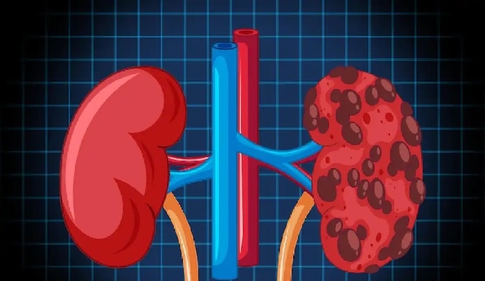 Kidney Disease Symptoms: కాళ్లు, చేతుల్లో ఈ లక్షణాలు కన్పిస్తే కిడ్నీలు పాడయినట్టే అర్దం