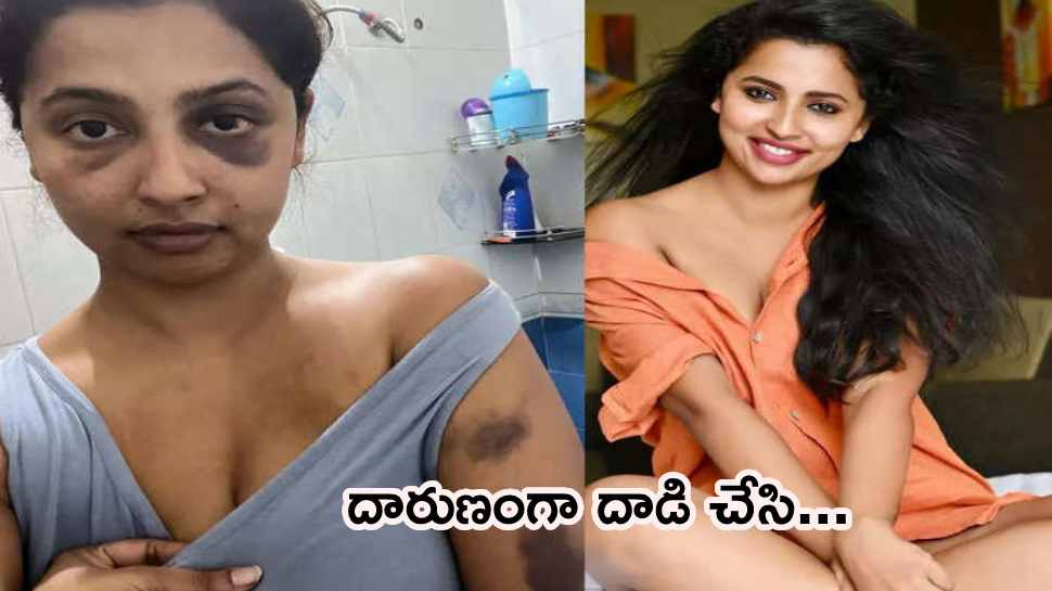 Anicka Vikramman: నటిని చచ్చేలా కొట్టిన ప్రియుడు.. కలకలం రేపుతున్న ఫొటోలు!