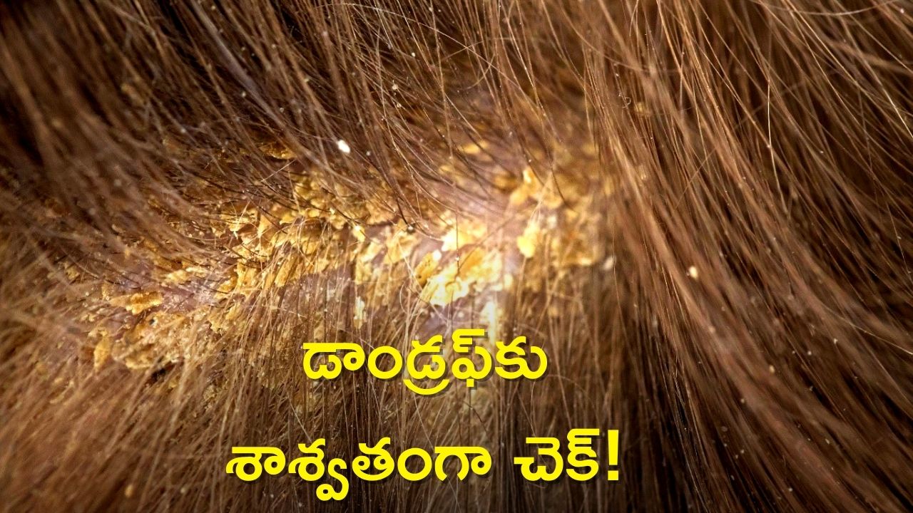 Anti Dandruff Oil: డాండ్రఫ్‌ను శాశ్వతంగా చెక్‌ పెట్టడానికి అద్భుత చిట్కా!