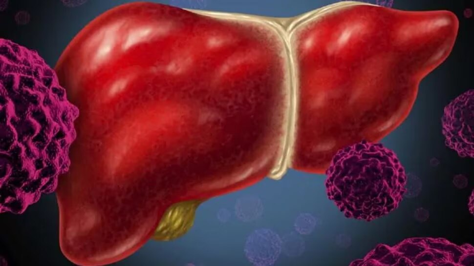 Fatty Liver: ఈ అలవాట్లు మానుకుంటే..ప్రాణాంతక ఫ్యాటీ లివర్ సమస్యకు చెక్ పెట్టవచ్చు