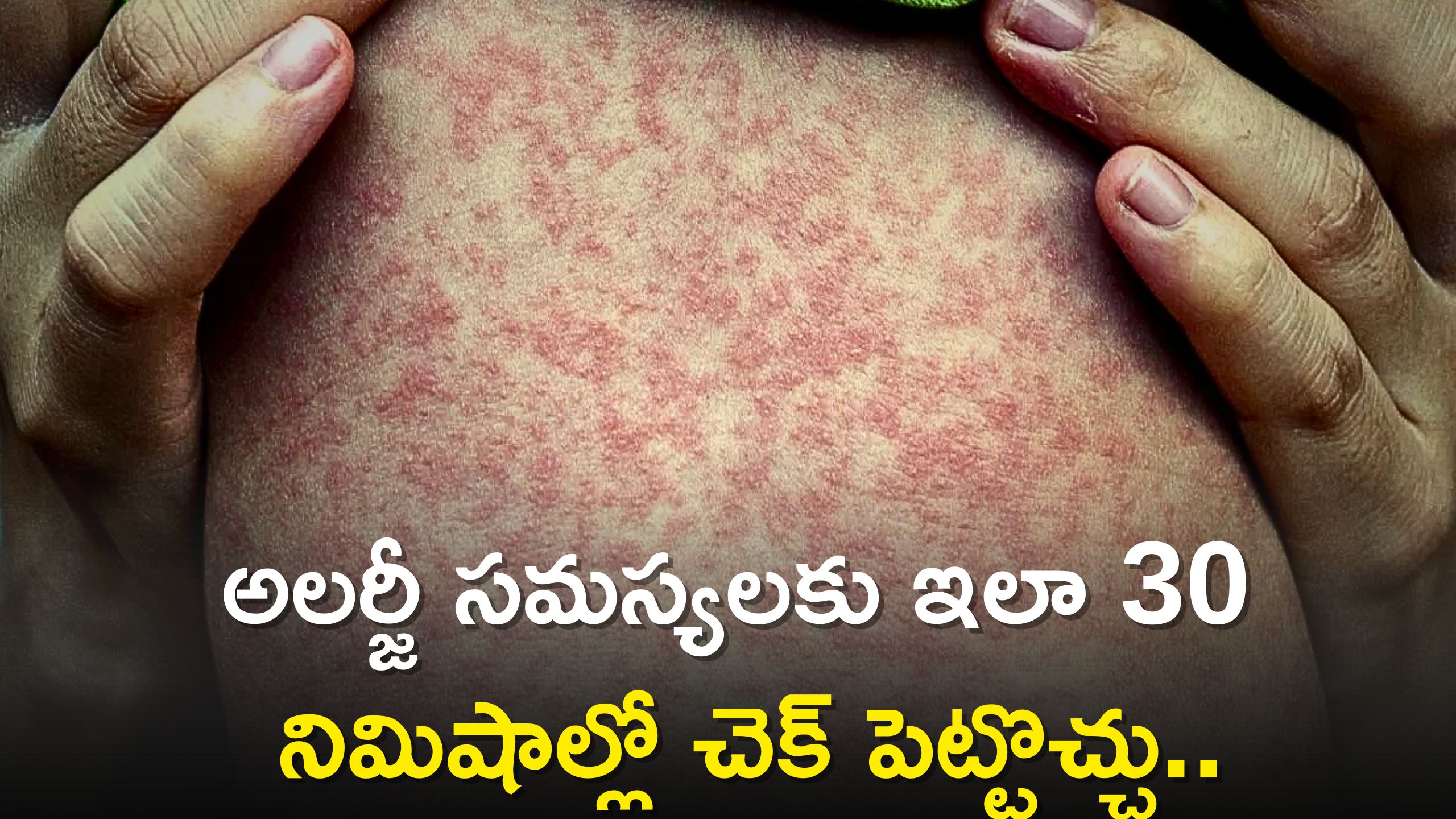 Remedies for Monsoon Skin Allergies: వర్షాకాలంలో అలర్జీలు అధికమే.. తగ్గించే ఇంటి చిట్కాలు అధికమే!