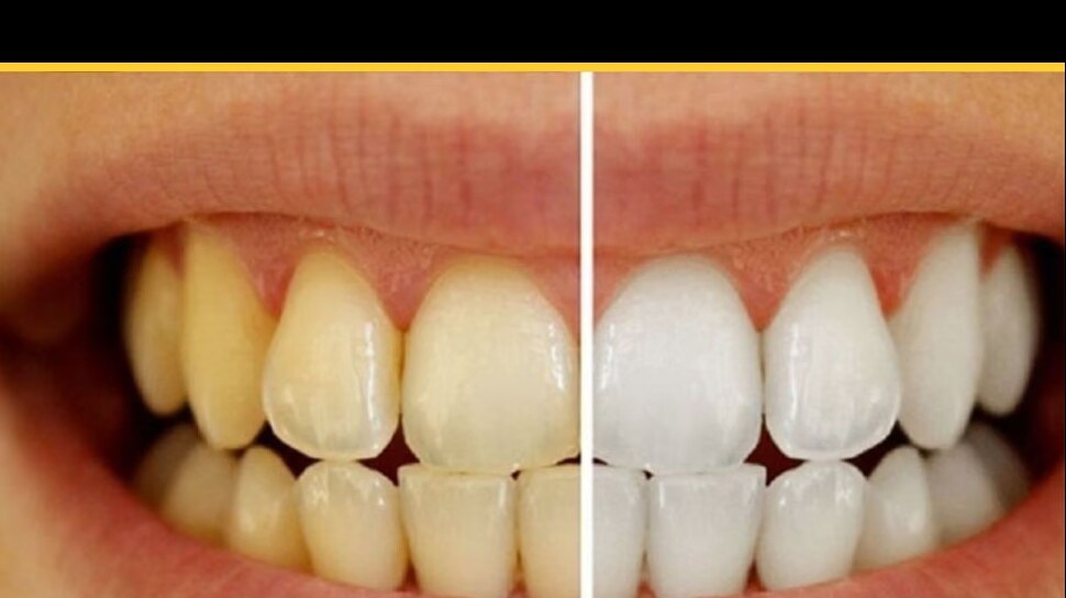 Tips For Teeth Whiten: ఈ టిప్స్ పాటించండి.. మీ దంతాలను తెల్లగా మెరిసేలా చేసుకోండి