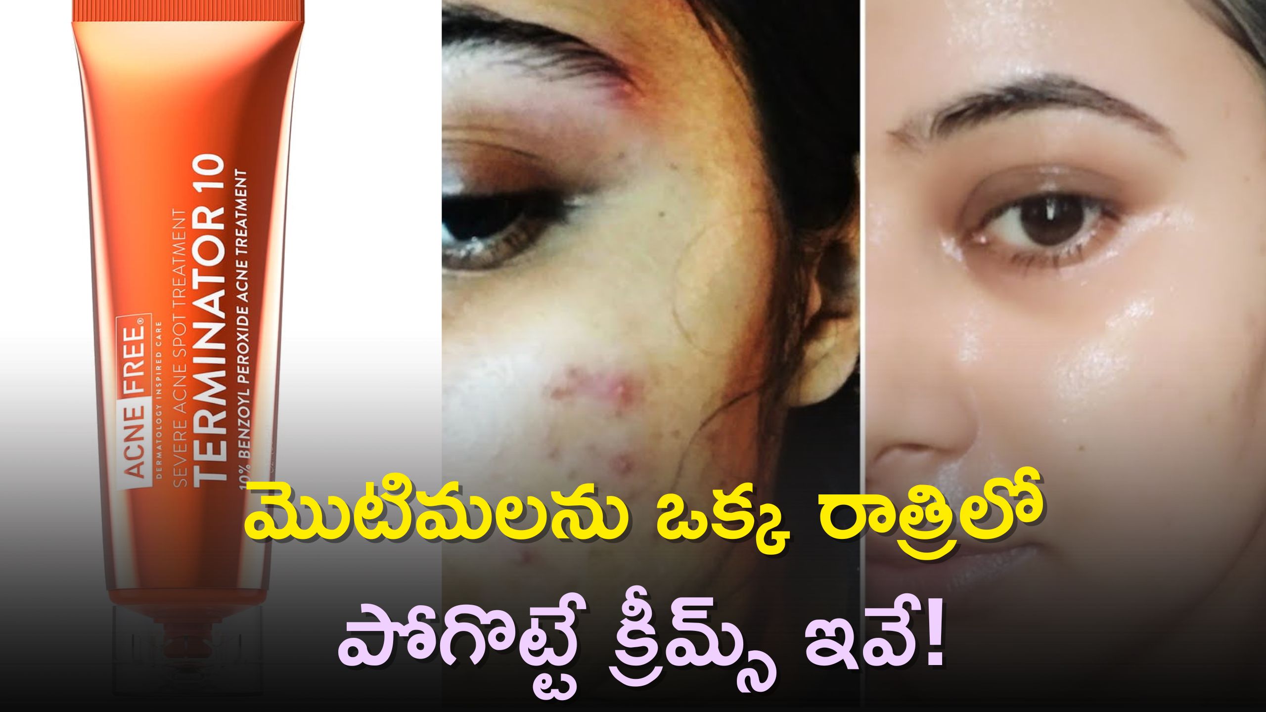These 5 Creams That Remove Pimples In One Night 5 Best Pimple Removal