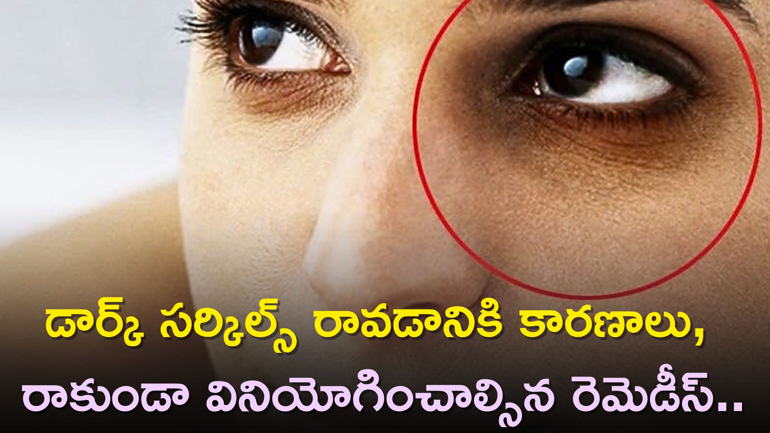 Reasons Of Dark Circles Around Eyes Precautions To Be Taken And Rid