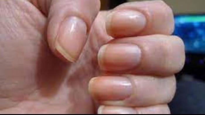 గోళ్ళు చెప్పే ఆరోగ్య రహస్యాలు | your nails tell your health in Telugu.. •  Hari Ome