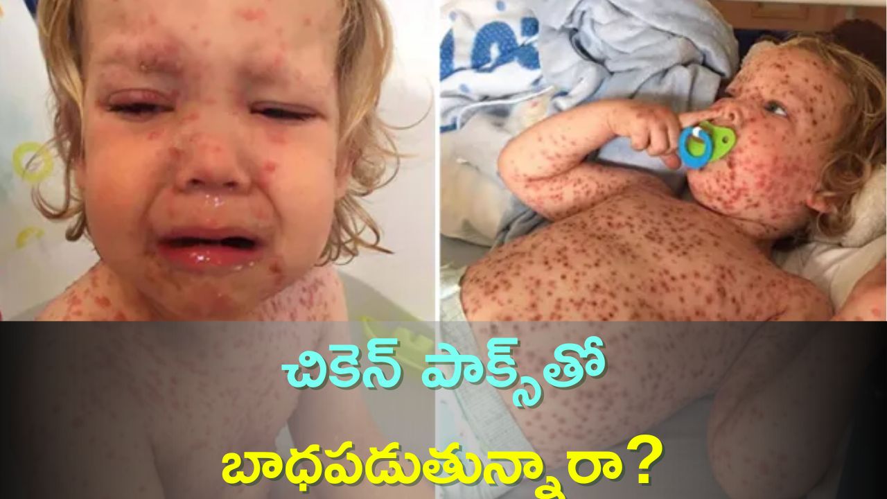 Chicken Pox Diet: These Are 5 Best Foods For Cure Chicken Pox | Chicken
