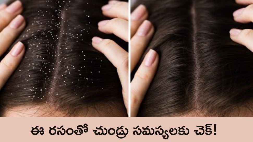 Hair Dandruff: ఈ రసంతో చుండ్రు సమస్యలకు చెక్‌!