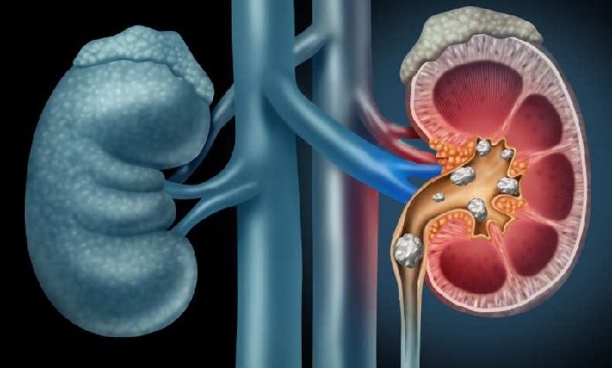 Kidney Stones: బీరు తాగితే కిడ్నీలో రాళ్లు పోతాయా, వాస్తవమేంటి