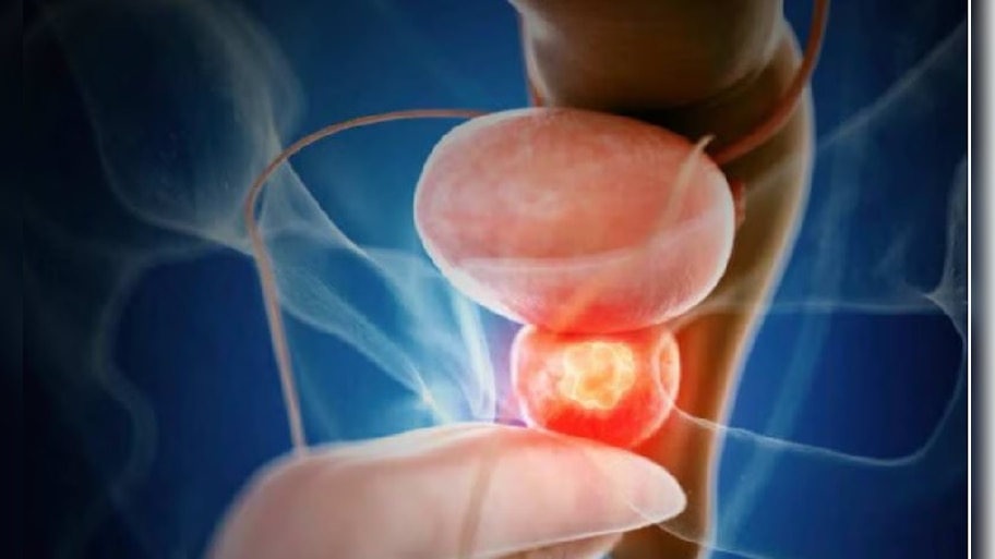 Prostate Cancer Signs: బాడీలోని ఈ 3 భాగాల్లో సమస్య ఉంటే ప్రోస్టేట్ కేన్సర్ కావచ్చు