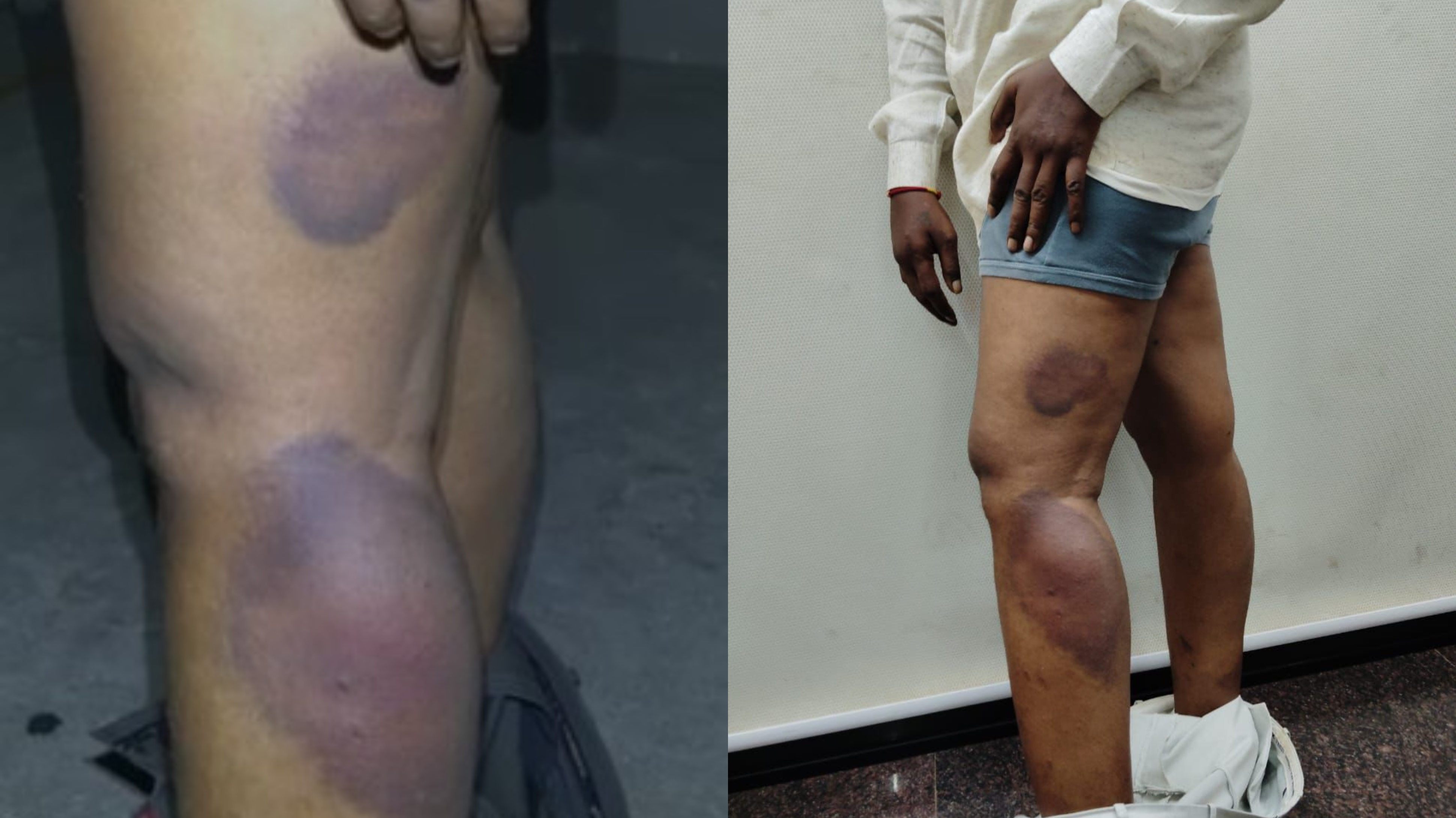 Third Degree: తెలంగాణ పోలీసుల మరో కర్కశత్వం.. వెలుగులోకి మరో థర్డ్ డిగ్రీ ప్రయోగం Third Degree: తెలంగాణ పోలీసుల మరో కర్కశత్వం.. వెలుగులోకి మరో థర్డ్ డిగ్రీ ప్రయోగం