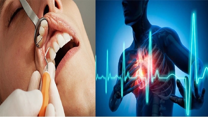 Root Canal and Heart: రూట్ కెనాల్ చికిత్సతో హార్ట్ ఎటాక్ వస్తుందా, నిజమేంటి