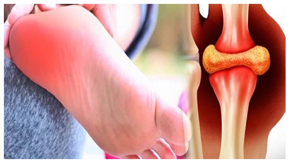 Uric Acid: యూరిక్ యాసిడ్ శాశ్వతంగా తగ్గించే 5 వంటగది మసాలాలు..