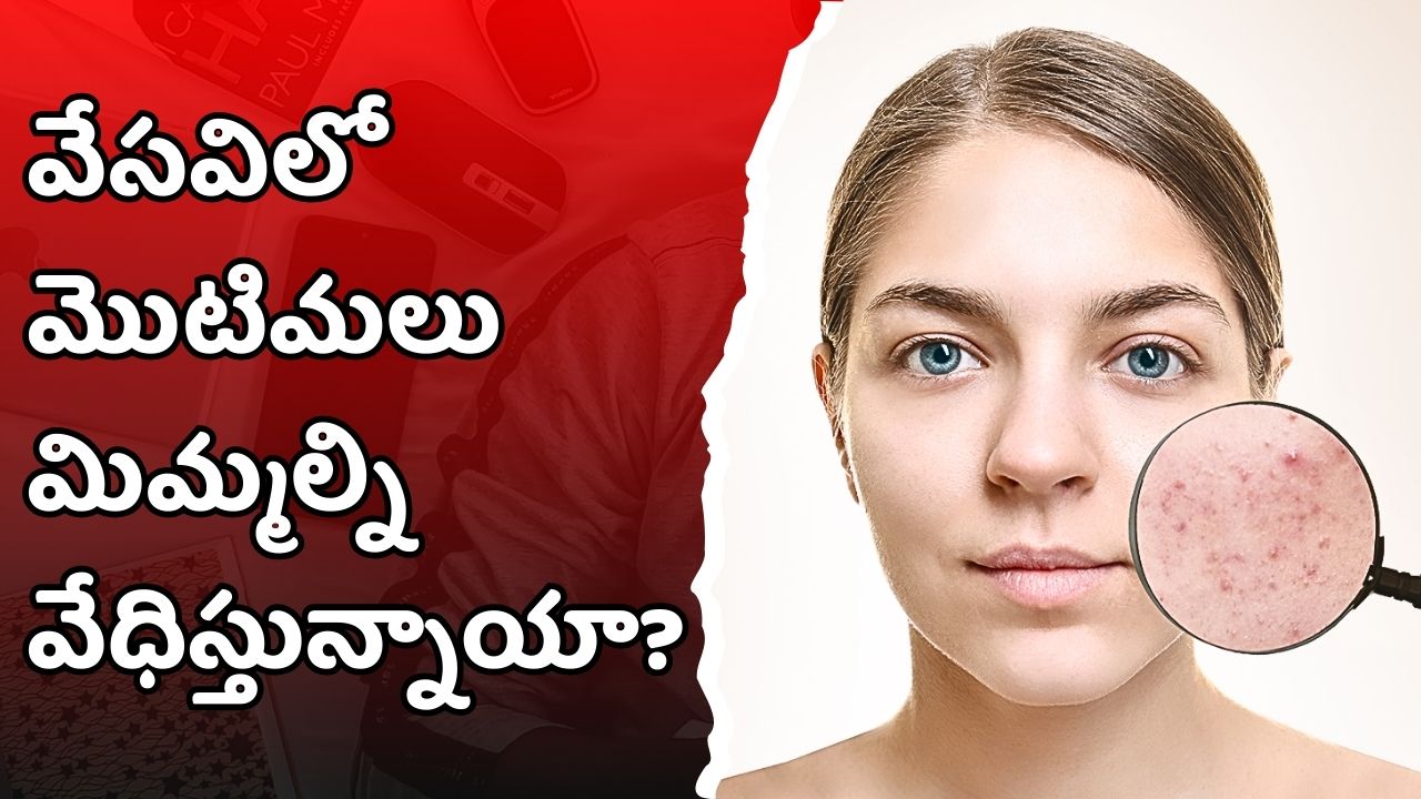 Pimple Remove Trick: వేసవిలో మొటిమలు మిమ్మల్ని వేధిస్తున్నాయా? ఇప్పుడే ఇవి తినడం మానుకోండి.. Pimple Remove Trick: వేసవిలో మొటిమలు మిమ్మల్ని వేధిస్తున్నాయా? ఇప్పుడే ఇవి తినడం మానుకోండి..