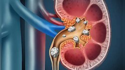 Kidney Stones: కిడ్నీలో రాళ్ల సమస్య బాధిస్తోందా, ఈ చిట్కాలతో మటుమాయం