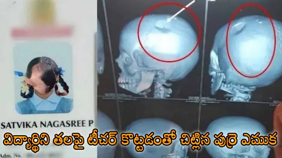 Skull Damage: ఓ టీచర్ నిర్వాకం.. అల్లరి చేస్తోందని విద్యార్థిని తలపై కొట్టడంతో చిట్లిపోయిన పుర్రె ఎముక.. ఎక్కడంటే..? Skull Damage: ఓ టీచర్ నిర్వాకం.. అల్లరి చేస్తోందని విద్యార్థిని తలపై కొట్టడంతో చిట్లిపోయిన పుర్రె ఎముక.. ఎక్కడంటే..?