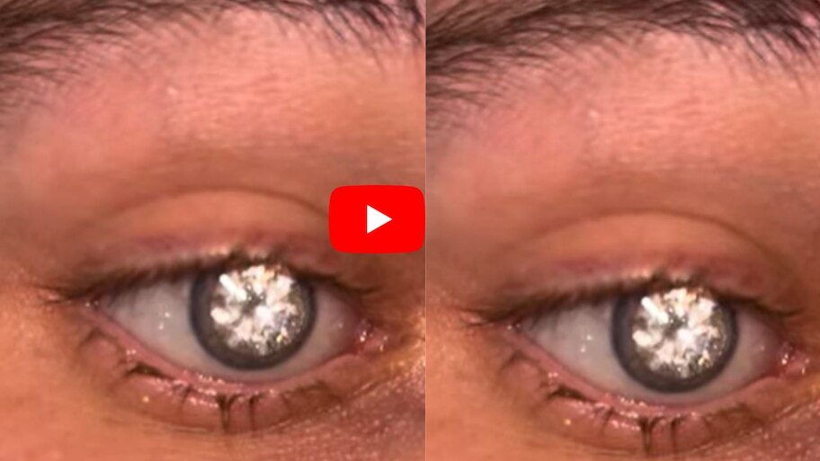 Diamond In Eye Video: యువకుడి కుడి కంటిలో 16 కోట్ల వజ్రం.. ఇది చూసి షాక్ అవుతున్న నెటిజన్స్.. వీడియో ఇదే..