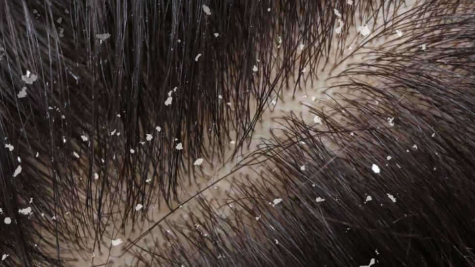 Anti Dandruff: చుండ్రును కూకటివేళ్లతో తొలగించే ఇంటి చిట్కాలు..! Anti Dandruff: చుండ్రును కూకటివేళ్లతో తొలగించే ఇంటి చిట్కాలు..!