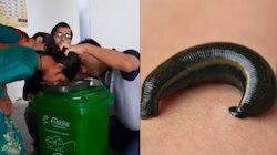Video Viral: ఓర్నాయనో.. రెండు నెలలుగా బాలిక ముక్కులోనే బతికున్న జలగ..?.. ఎలా తీశారో 