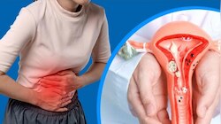 Endometriosis: నెలసరి నొప్పి నుంచి సంతానలేమి సవాళ్ల వరకూ.. మహిళలు ఎదుర్కొంటున్న సమస్యలు ఇవే..!