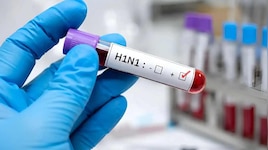 H1N1 Virus Explained:H1N1 వైరస్ అంటే ఏమిటి? లక్షణాలు, వ్యాప్తి, జాగ్రత్తలు ఇవే..!