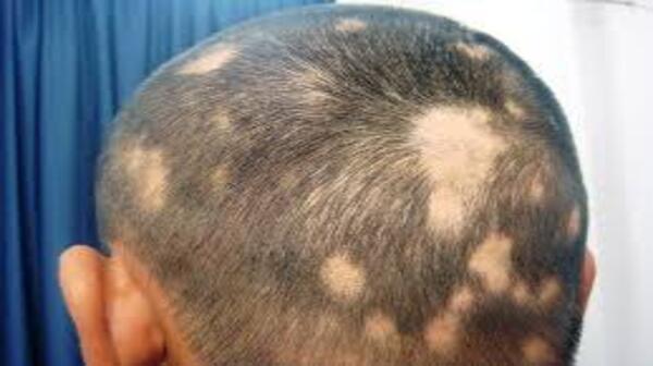 Curry Leaves For Hair Growth