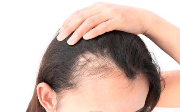 Sweat And Hair Loss