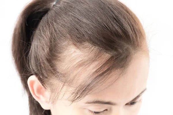 Hair Fall Prevention 